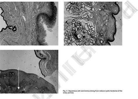 Figure 1 From A Rare Case Report Of Squamous Cell Carcinoma Arising