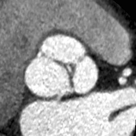 Cardiac Ct For The Differentiation Of Bicuspid And Tricuspid Aortic Valves Comparison With