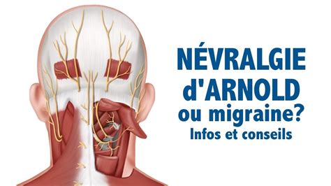 N Vralgie D Arnold Ou Migraine Infos Et Conseils Youtube