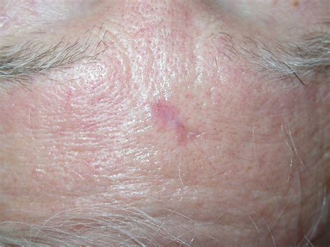 Basal Cell Cancer Bcc Skin Repair