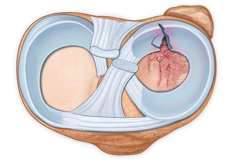 Meniscus Repair Surgery For Torn Knee Cartilage