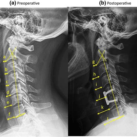 Pre Vertebral Soft Tissue Thickness And Hyoid Vertebral Distance