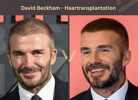 Promis Mit Haartransplantation 35 Vorher Nachher Fotos