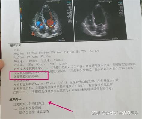 妈妈确诊乳腺癌（七） 第二次化疗 白蛋白紫杉醇化疗药的副作用 知乎