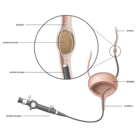 Ureteropyeloscopy & Ureteroscopy Melbourne | Urologist in Melbourne