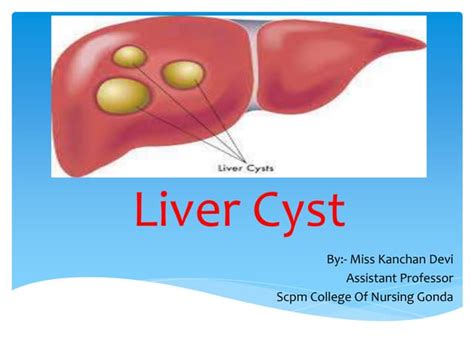 Liver Cyst Pptx