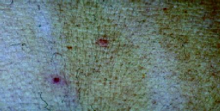 Rose spots-like skin lesion on the trunk (day 4). | Download Scientific ...