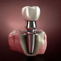 Costa Rica Dental Center Discount Prices Dental Implants