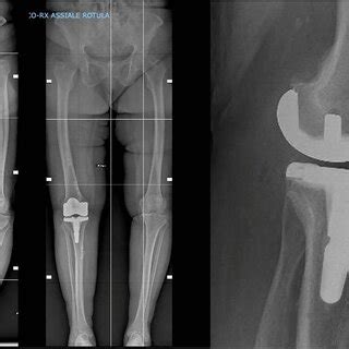 Postop Anteroposterior And Lateral X Rays The Lateral View Shows The