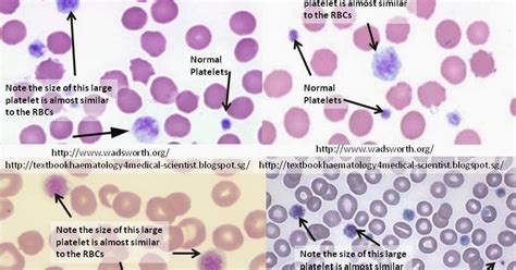 Haematology In A Nutshell Large Platelets