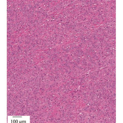 A Microscopic Findings Show The Tumor With Epithelioid Short