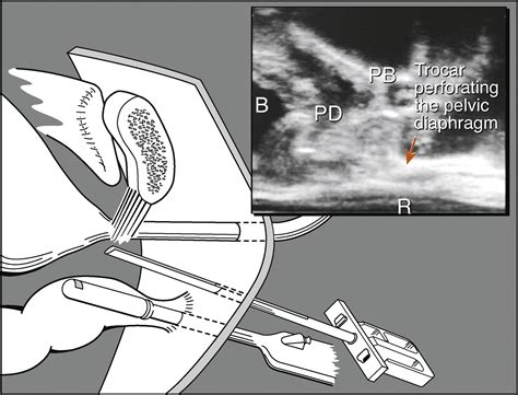 Transrectal UltrasoundGuided Implantation Of Adjustable Continence