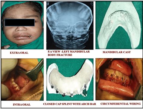 Case Showing Left Mandibular Body Fracture And Its Management Using