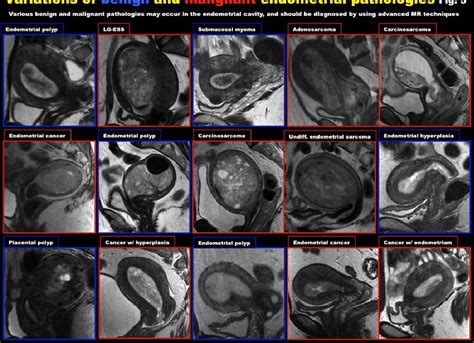 Endometrial Carcinoma Diagnostic Strategy By Using Advanced Mr