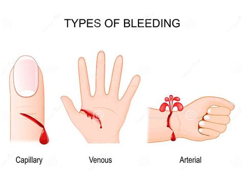 Types of Bleeding. a Capillary, Venous and Arterial Blood Loss Stock ...