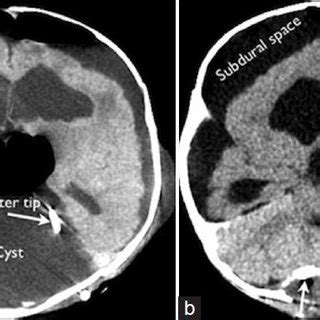 Postoperative Ct Scan A And Month Follow Up Ct Scan B Showing