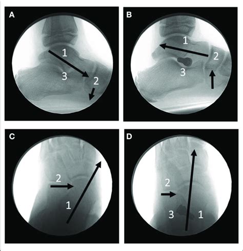 Full Weightbearing Relaxed Stance Position Fluoroscopic Radiographs