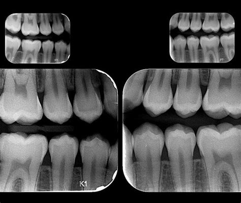 Serie Periapical Estándar Imax