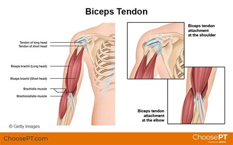 Guide Physical Therapy Guide To Biceps Tendon Rupture Choose Pt