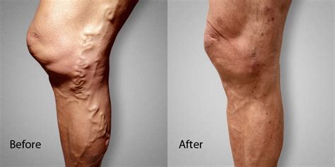 Before After Photos L Advanced Varicose Vein Treatments Of Manhattan NYC