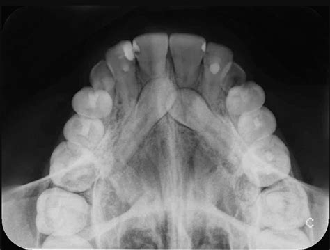 Radiograf A Maxilar Superior Rxdiagnostic