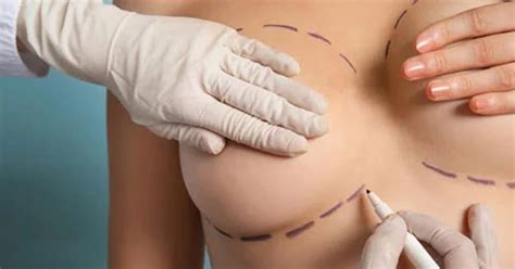 Breast Implants Revision Procedure Cost Photos Belorens