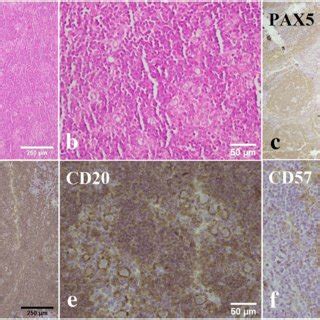 Pattern A Immunoarchitecture In One Of The Cases A And B The H E Slide