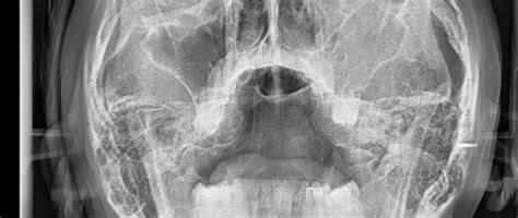 Inicio Oral Rx Diagnóstico Radiológico Radiografías Intraorales Radiografías Extraorales