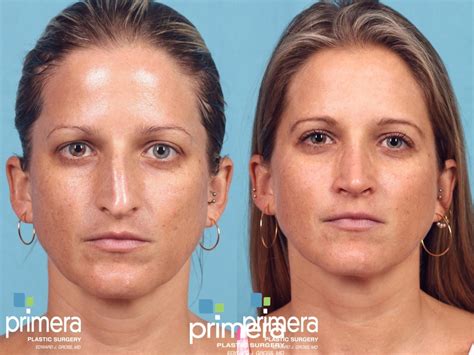 Rhinoplasty Before And After Pictures Case 201 Orlando And Tampa