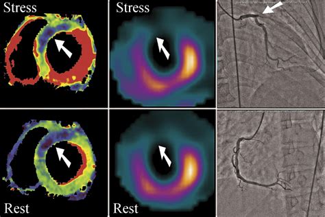 Stress And Rest Dynamic Myocardial Perfusion Imaging By Evaluation Of