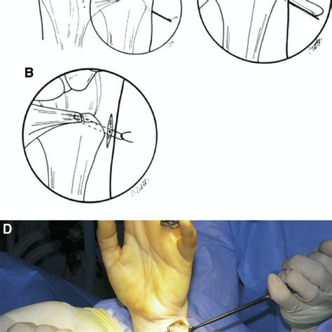 Pdf New Advances In Wrist Arthroscopy