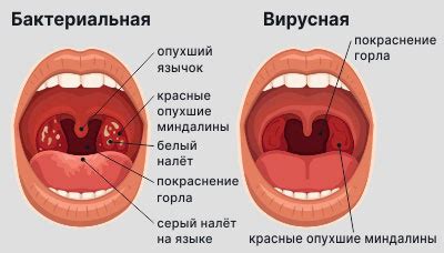 Ангина у ребенка - типы, симптомы, лечение и профилактика
