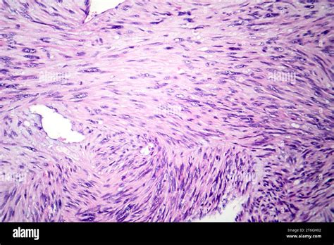 Photomicrograph Of Leiomyosarcoma Depicting Malignant Smooth Muscle