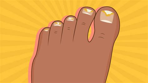 What Does Cancer Of The Big Toenail Look Like Here S Why You Should