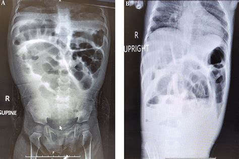 Plain Abdominal X Ray A Supine Abdominal X Ray And B Upright X Ray Download Scientific