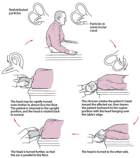 What Causes Bppv And Treatment Options — Corona Station Physical