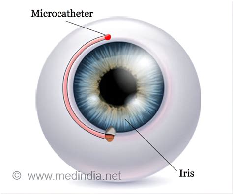 Canaloplasty Indications Preparation Procedure Recovery