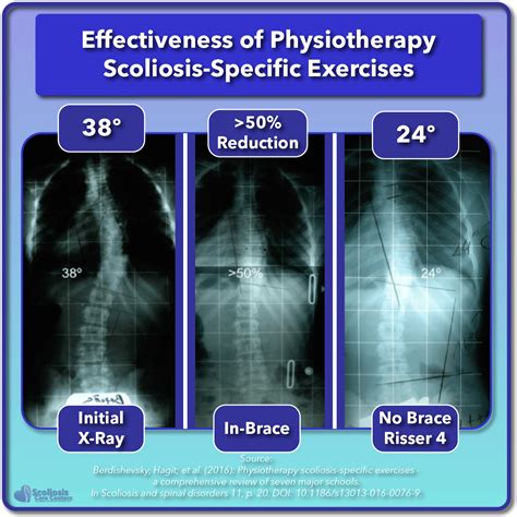 Scoliosis Treatment for Children and Teens - Scoliosis Care Centers