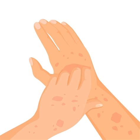 Premium Vector Rash Skin On Hand Rashes Itching Hands Scratch Arm In