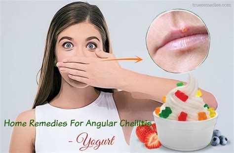 25 Natural Home Remedies For Angular Cheilitis Infection Fast