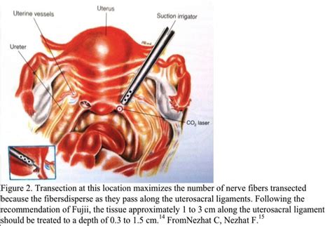 Uterosacral Ligament Endometriosis