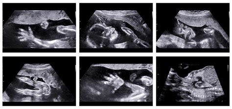 DiagnÓstico Prenatal EcografÍas 3d Y 5d Embriogyn