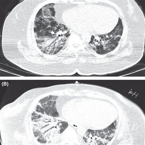 Chest Ct Scan Showing The Evidence Of Tracheoesophageal Fistula The Download Scientific