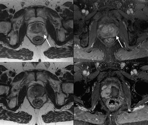 Dynamic Contrast Enhanced Mri In Prostate Cancer European Journal Of