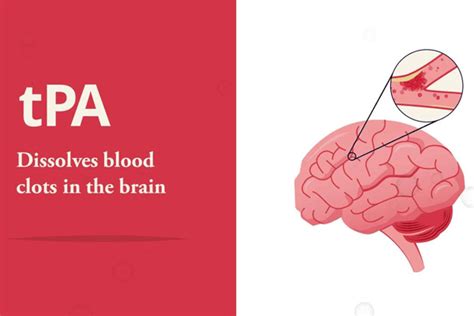 Ischemic stroke treatment