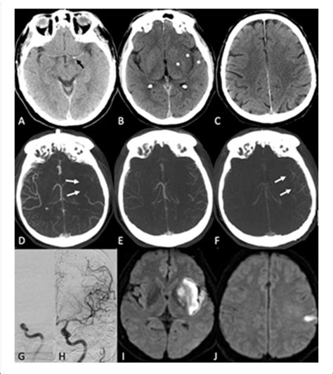 Acute Ischemic Stroke Due To A Terminal Internal Carotid Artery Download Scientific Diagram