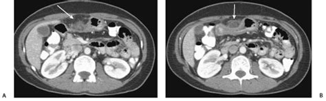 116 Focal Omental Infarction Radiology Key