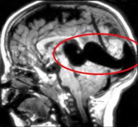 Vein of Galen Malformation » Lillian S. Wells Department of ...