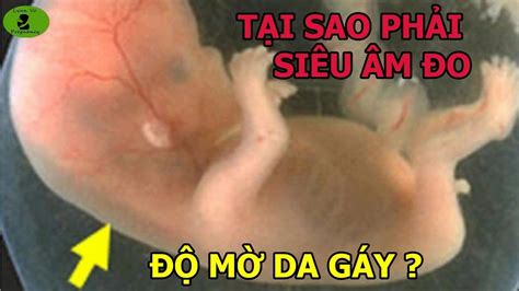 Siêu Âm Đo ĐỘ MỜ DA GÁY là Gì Độ Mờ Da Gay Bao Nhiêu Là An Toàn Cho Baby YouTube
