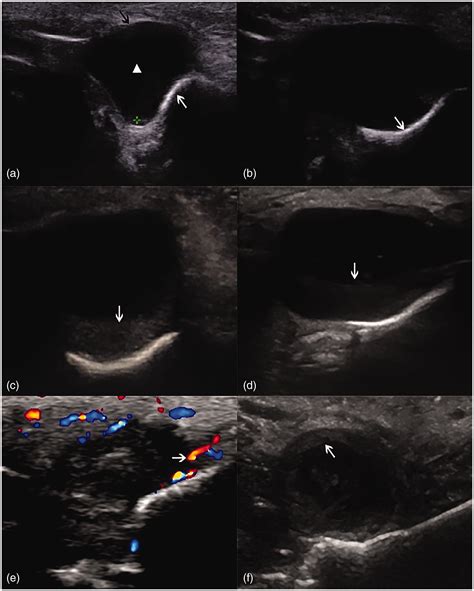 Nasolabial Cyst Radiology